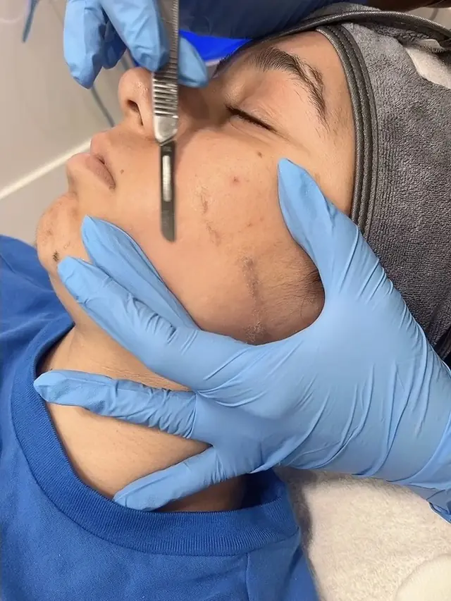 Dermaplaning or a chemical peel?