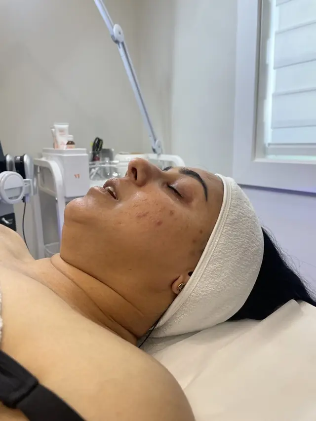 A radiofrequency handpiece used on the face