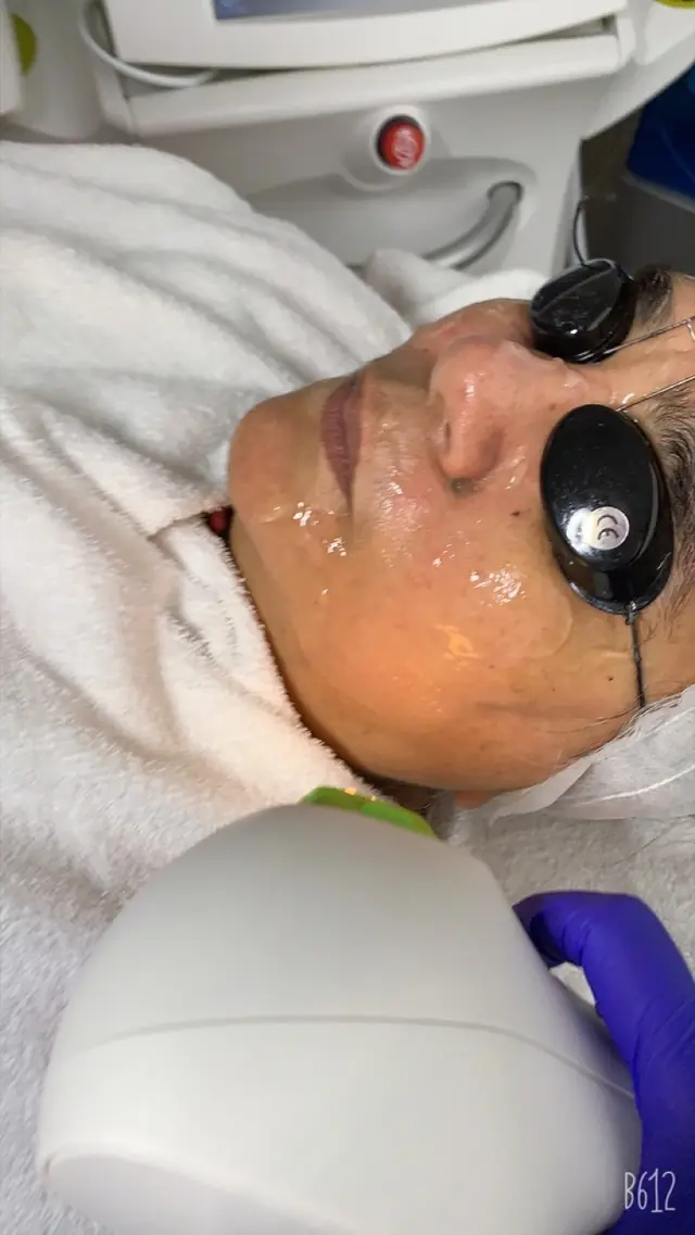 A client in protective eyewear during a laser treatment