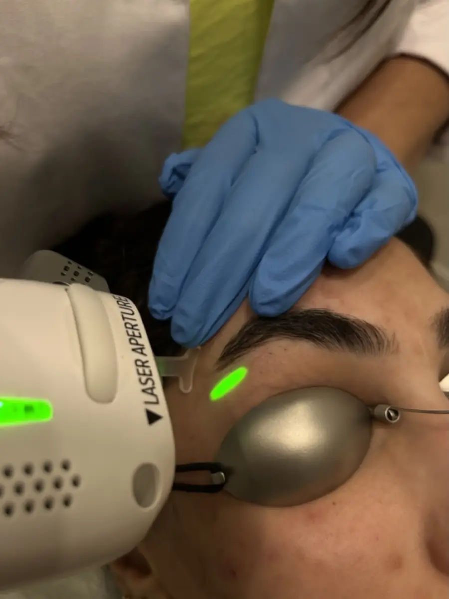 A laser handpiece working on the skin