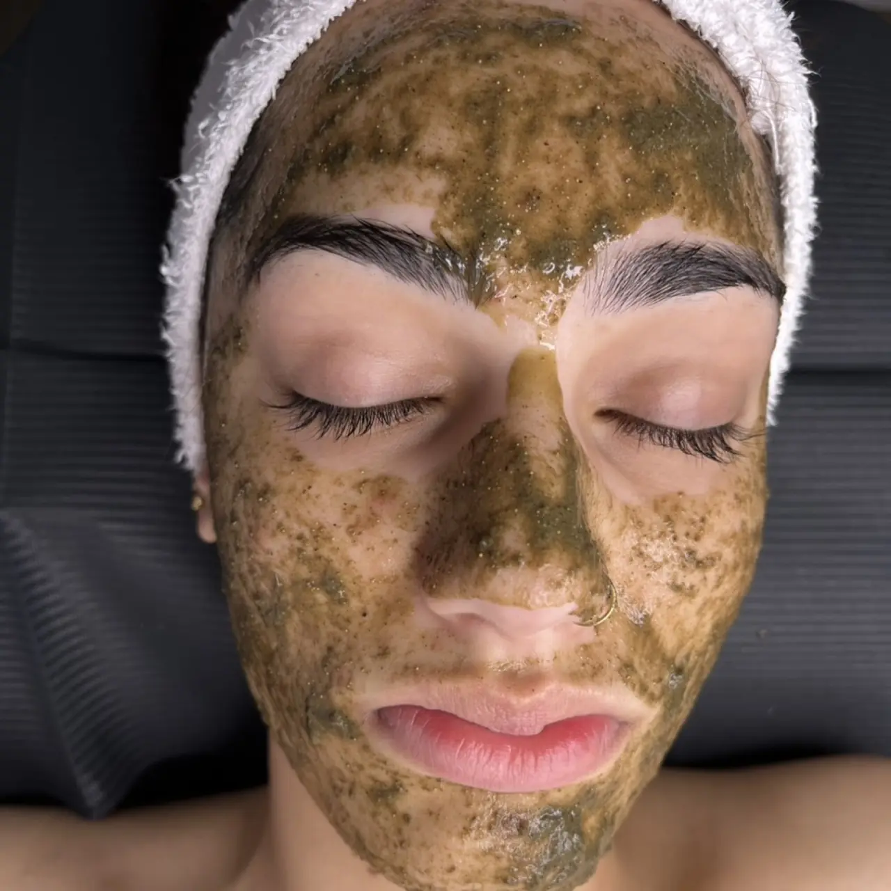 A depigmentation mask in place during treatment
