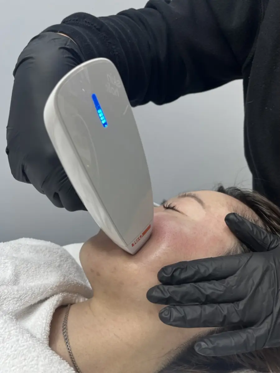 A radiofrequency handpiece on a client’s cheek