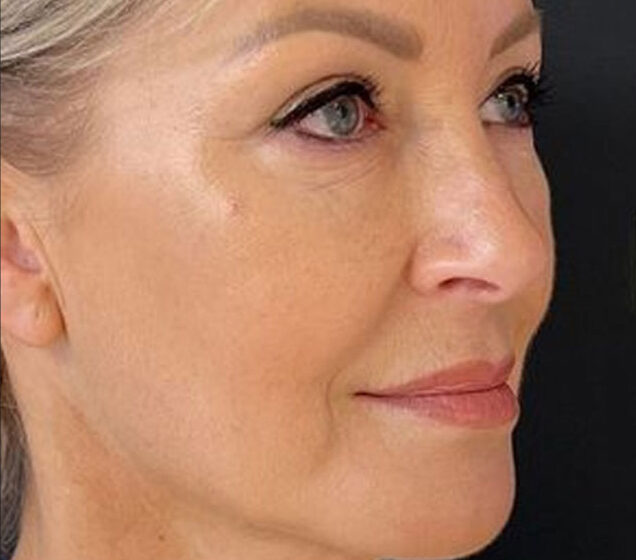 XERF Non-Surgical Facelift