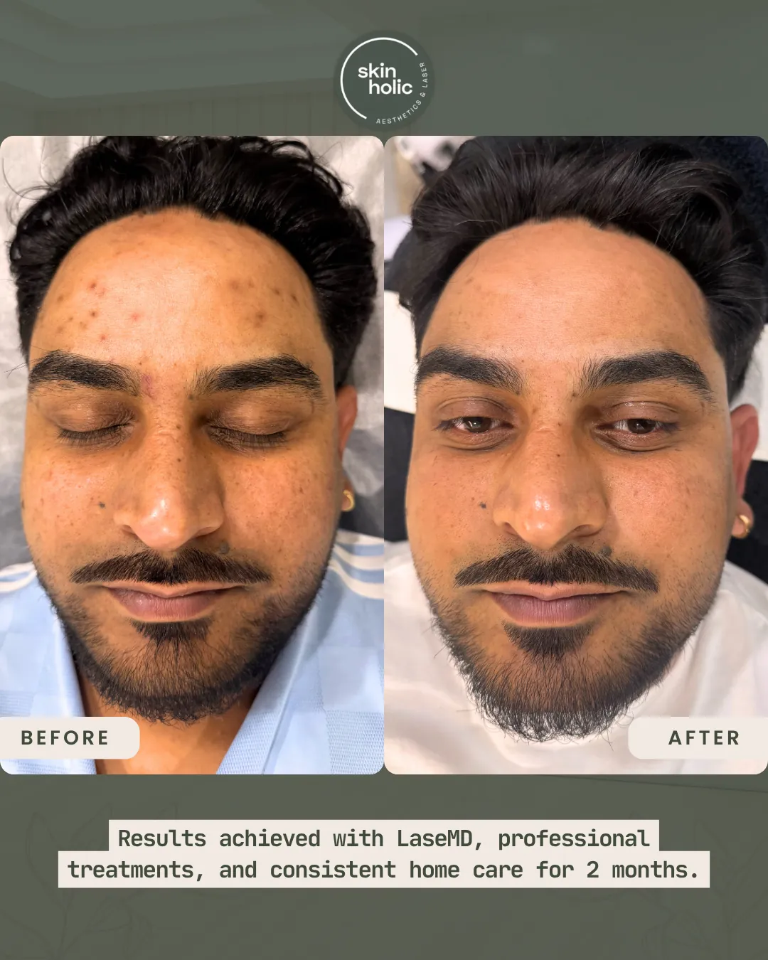 Before and after laseMD, professional treatments and two months of consistent home care.