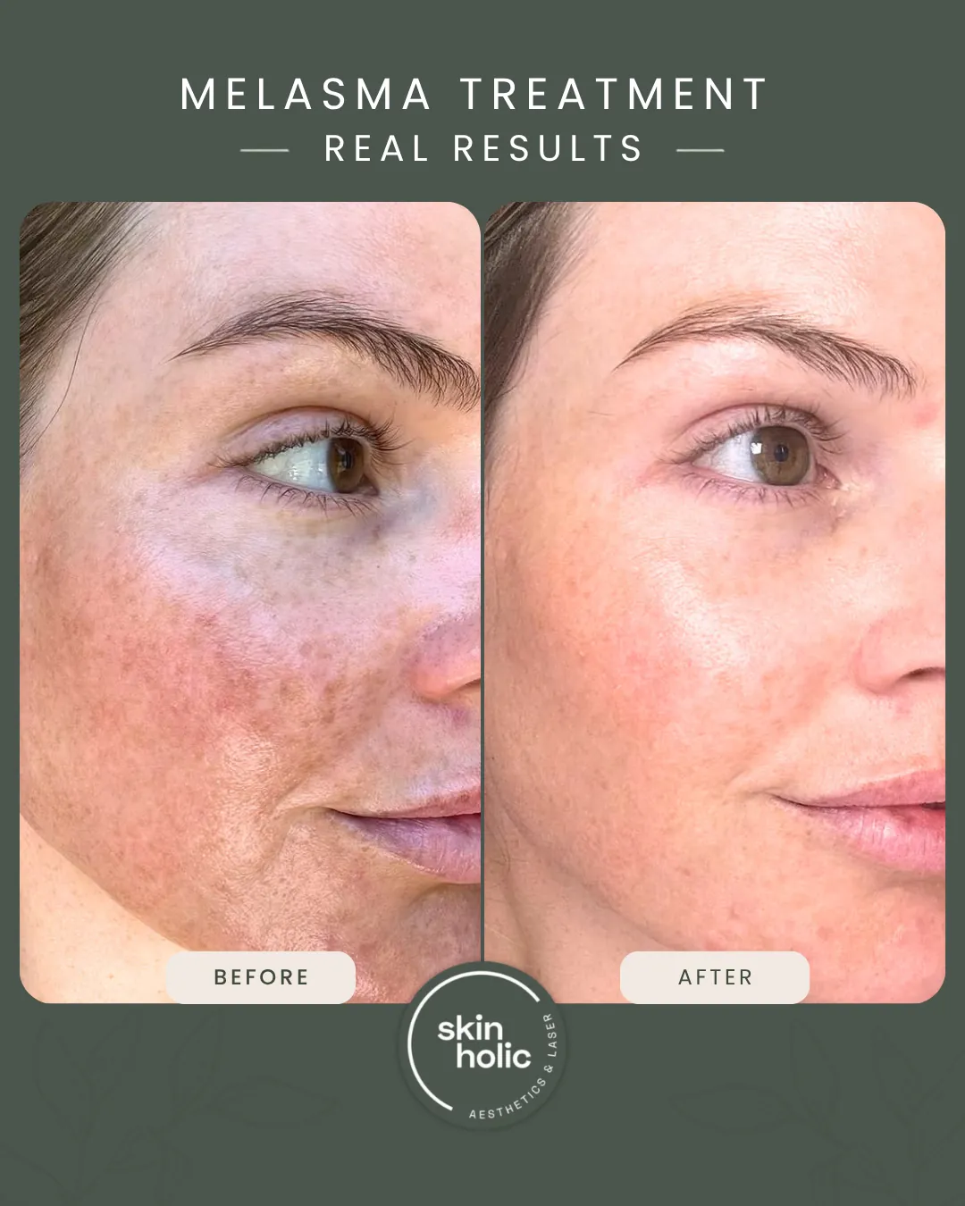 Before and after a customised melasma treatment plan.
