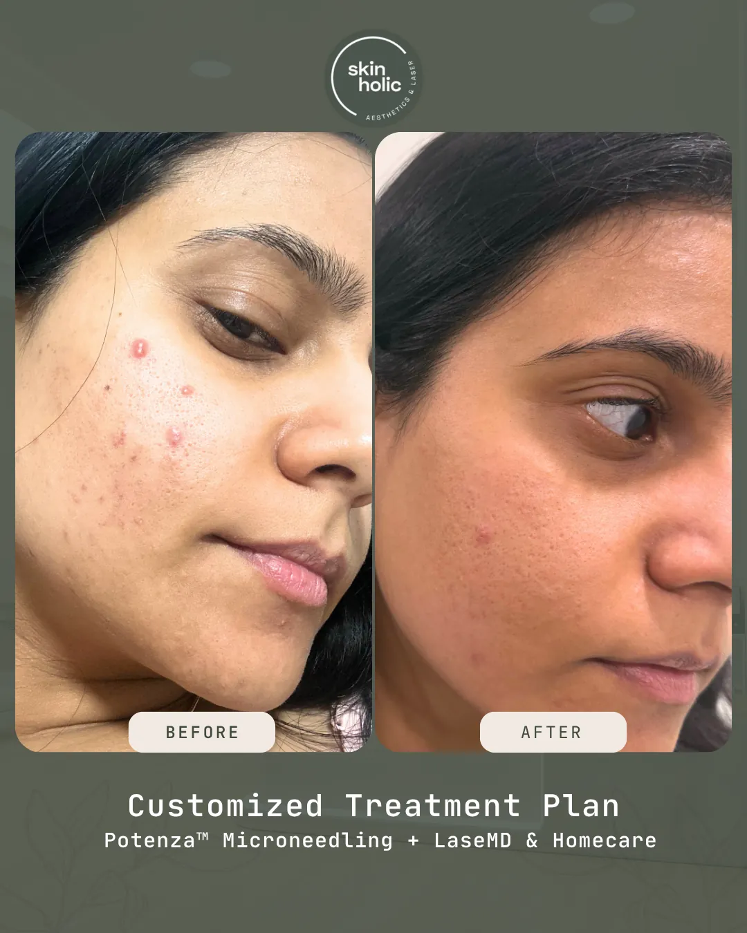 Before and after: Potenza microneedling + LaseMD.