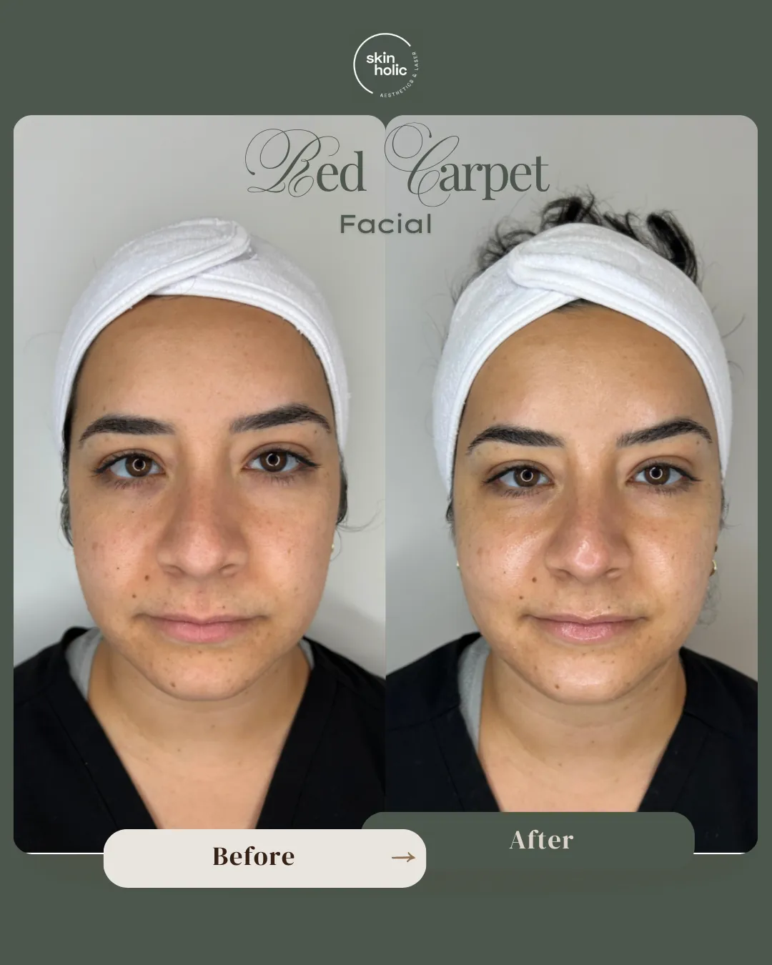 Before and after: Red Carpet Facial.