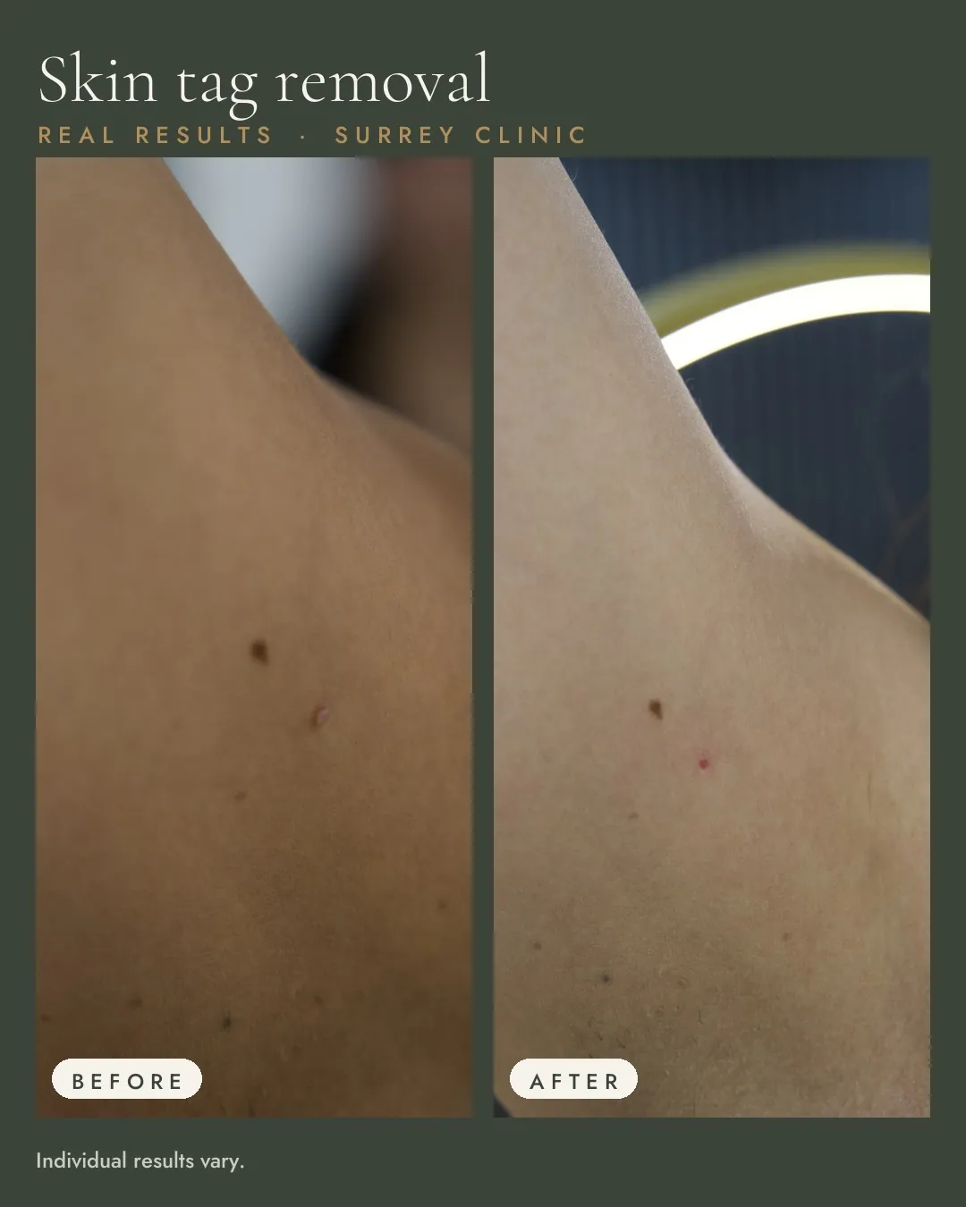 Before and after: Skin tag removal.