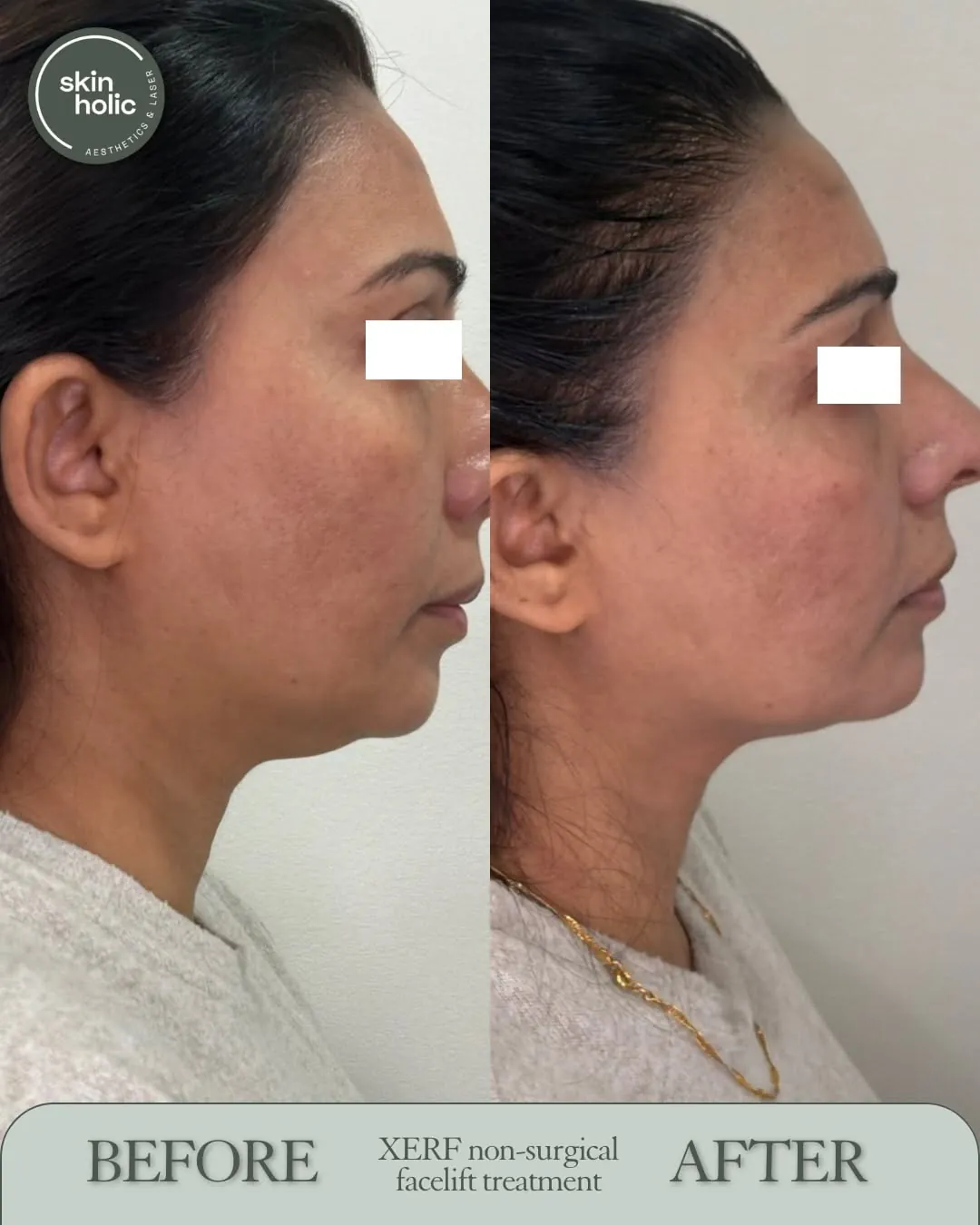 Before and after a XERF non-surgical facelift, in profile.