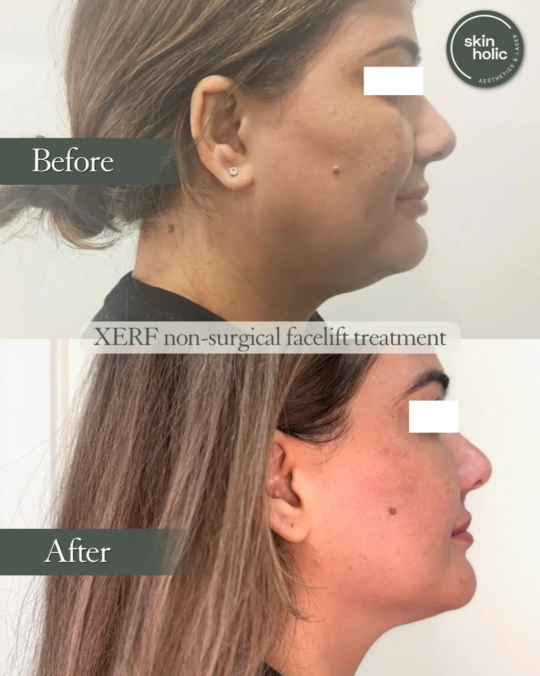 Before (top) and after (bottom) a XERF non-surgical facelift treatment