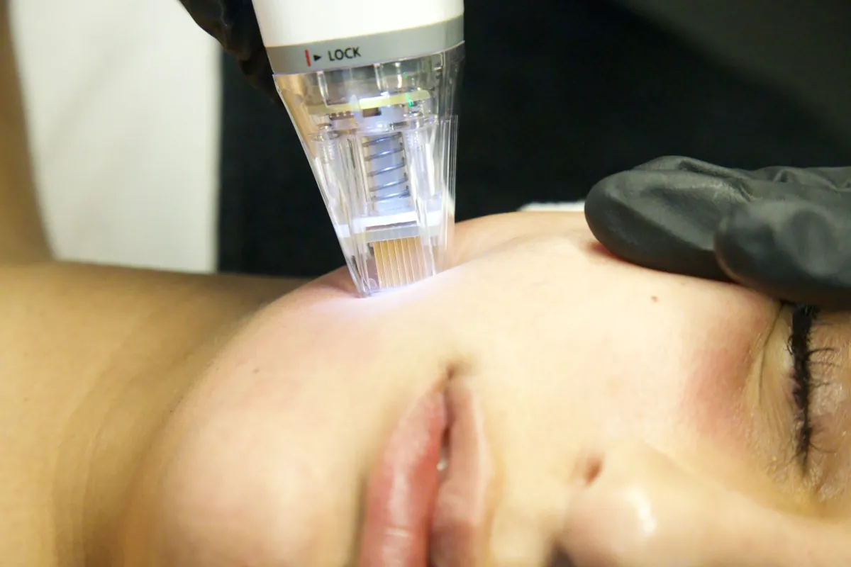 An RF microneedling tip in use, up close